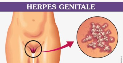 Herpes genitale: cosa succede in caso di contagio