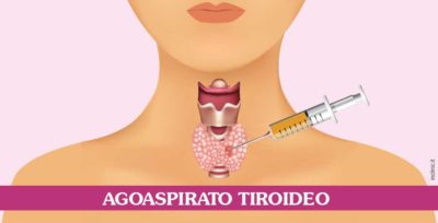 agoaspirato-tiroideo-roma