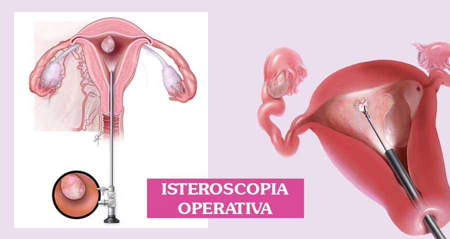 isteroscopia-operativa-roma3