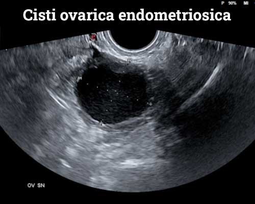 cisti-ovarica-endometriosica senoclinic roma