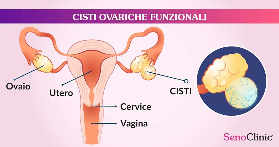 cisti-ovariche-funzionali