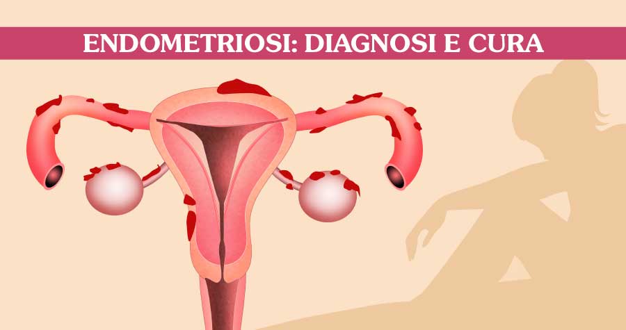 endometriosi-diagnosi-e-cura-ginecologo-roma