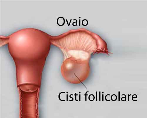 cisti-follicolare-senoclinic