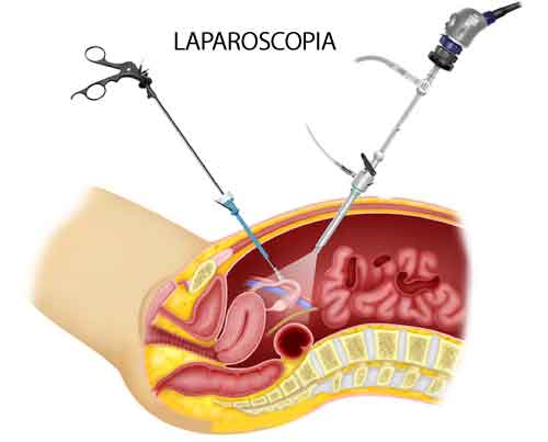 laparoscopia-senoclinic