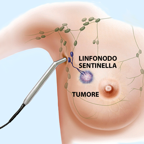 asportazione linfonodo-sentinella-senoclinic
