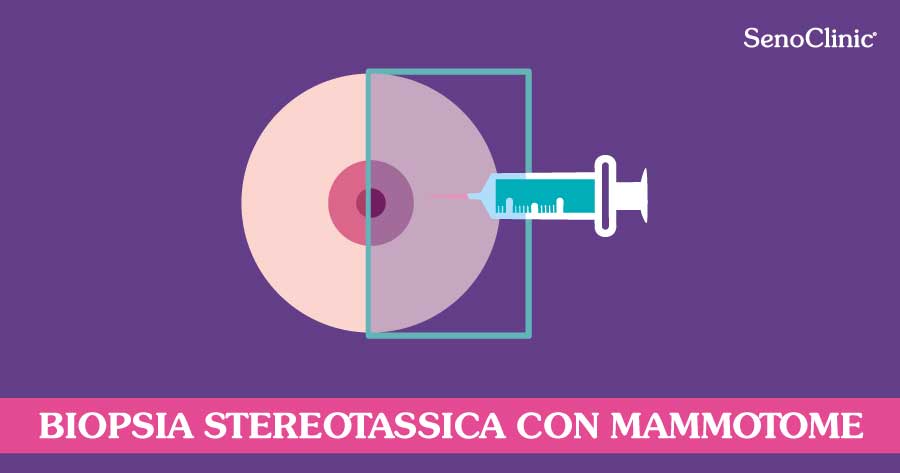 biopsia-stereotassica-mammotome-roma-senoclinic