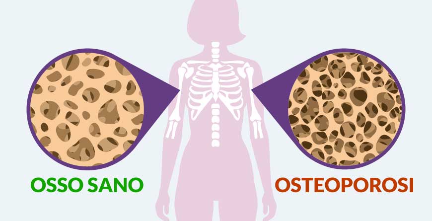 osteoporosi-come-si-presenta-