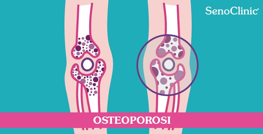 osteoporosi diagnosi e trattamento roma senoclinic