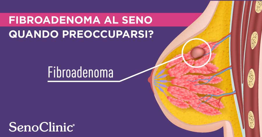 fibroadenoma-al-seno-quando-preoccuparsi-senoclinic-roma