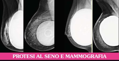 Protesi al seno e mammografia