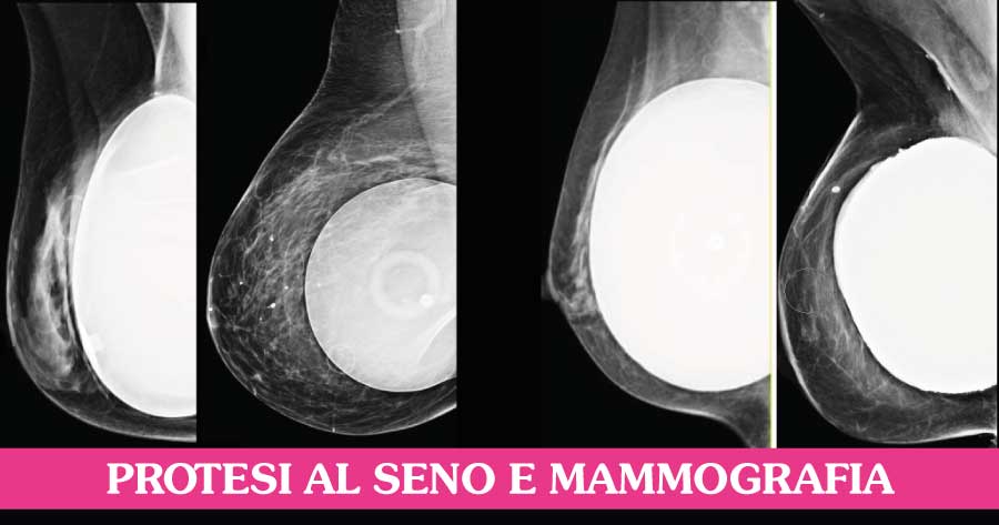 protesi-al-seno-e-mammografia-senoclinic-roma