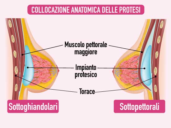 collocazione-protesi-al-seno-senoclinic-roma
