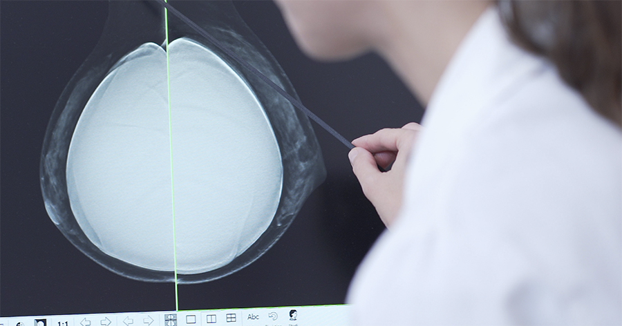 importanza ecografia mammaria nelle donne con protesi