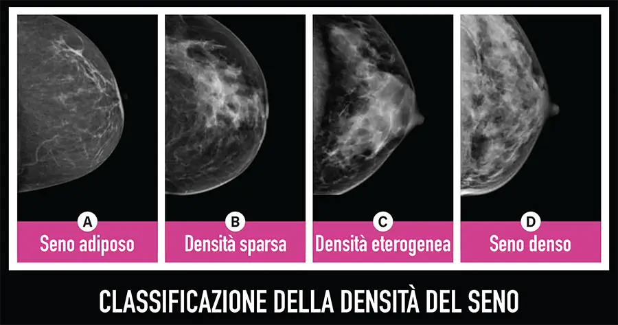 Cos'è il seno denso senoclinic roma