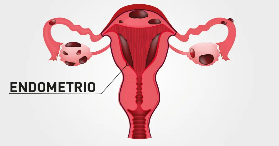 endometriosi dr delfini senoclinic roma