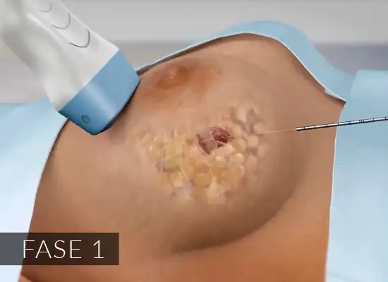 immagine crioablazione dei noduli al seno