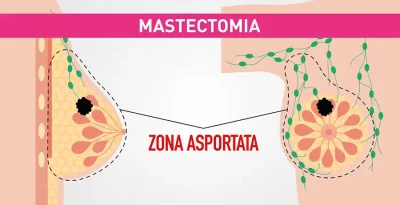 In cosa consiste la mastectomia