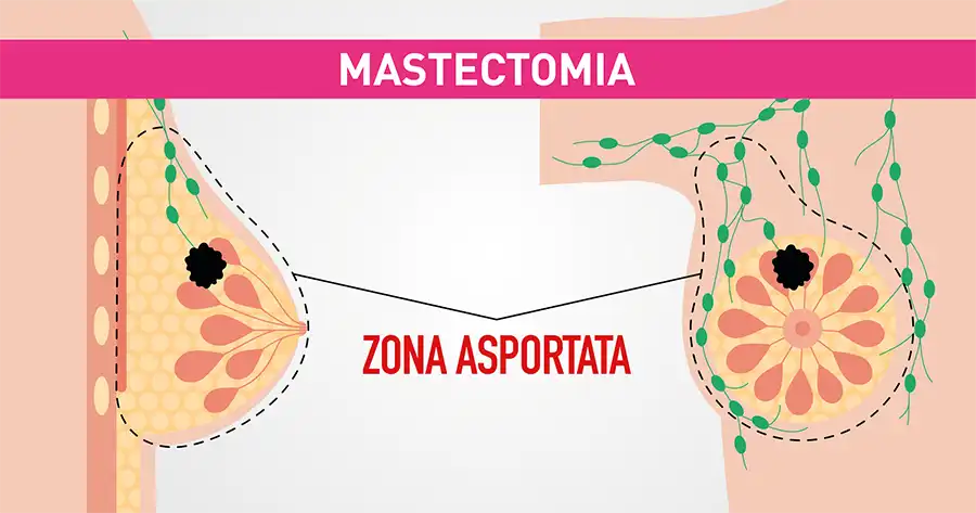 in cosa consiste la mastectomia senoclinic